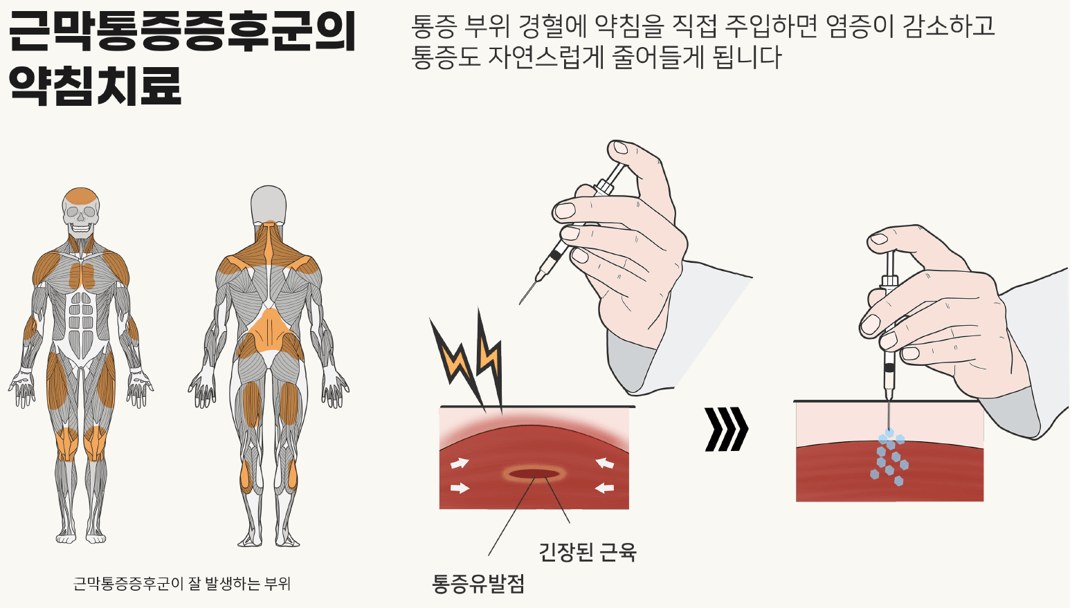 /images/02-korean-medicine/image21.png 근막통증증후군의 약침치료 원리