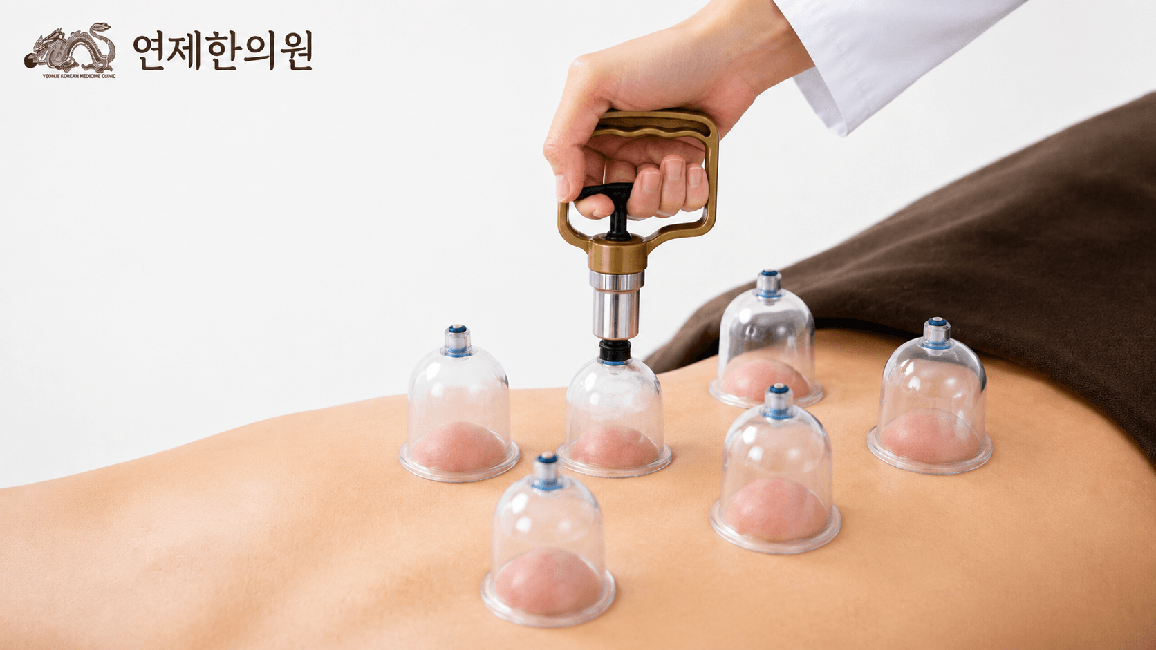 /images/02-korean-medicine/km-cupping.png 부항치료 시술 모습