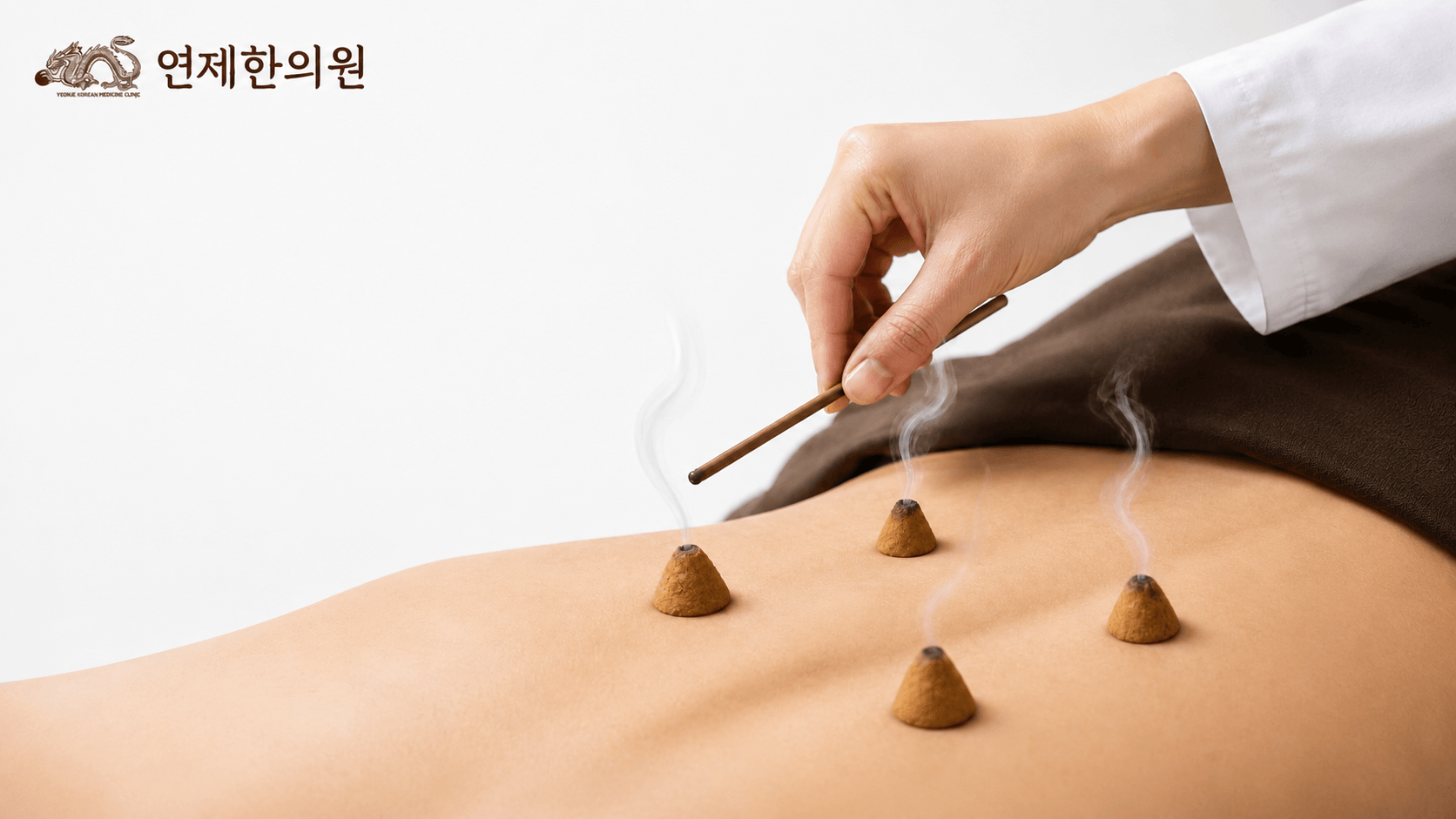 /images/02-korean-medicine/km-moxa.png 뜸치료 시술 모습