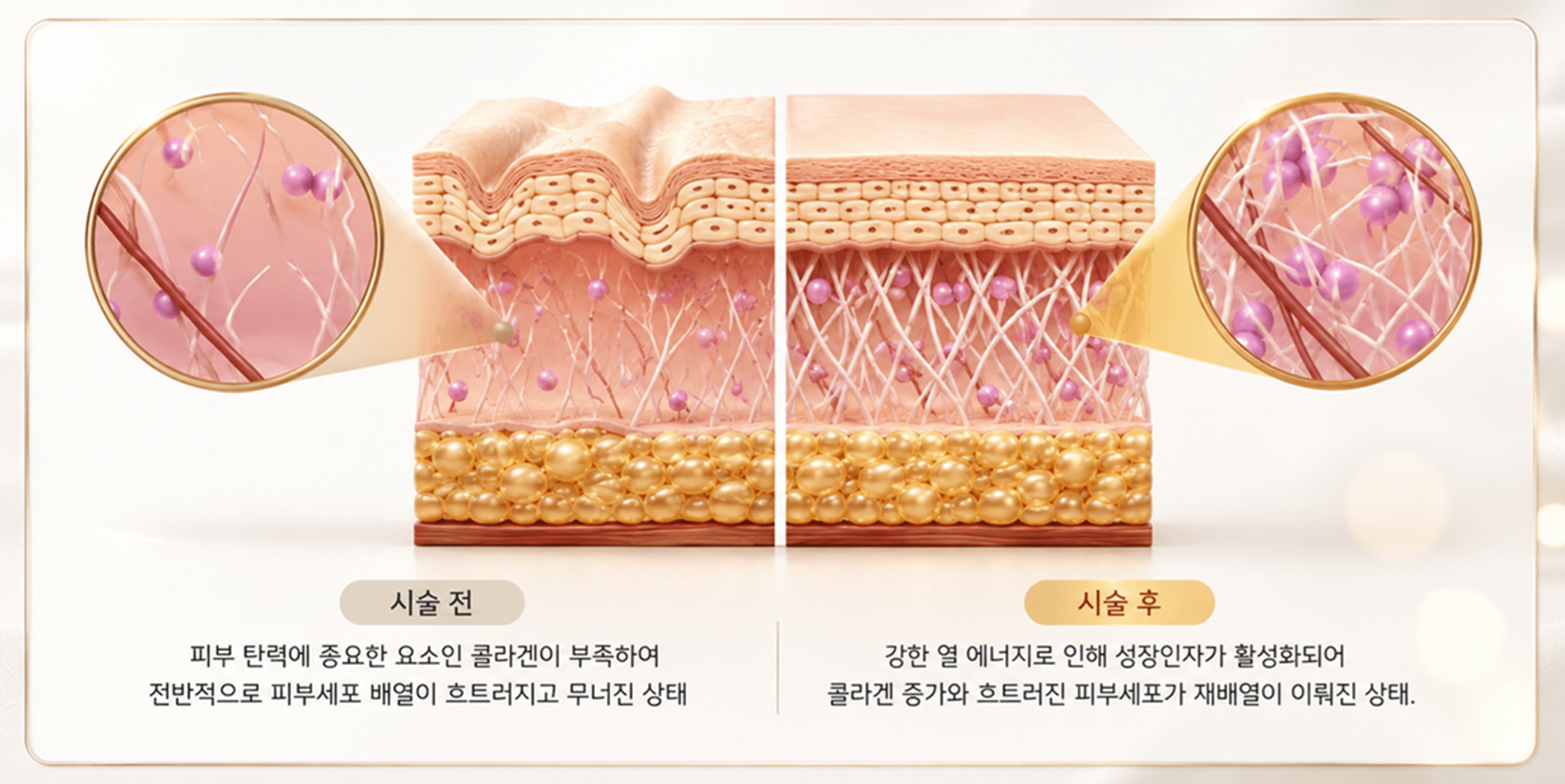 /images/06-skincare/ncore-before-after.png N.CORE PRIME 시술 전·후 비교