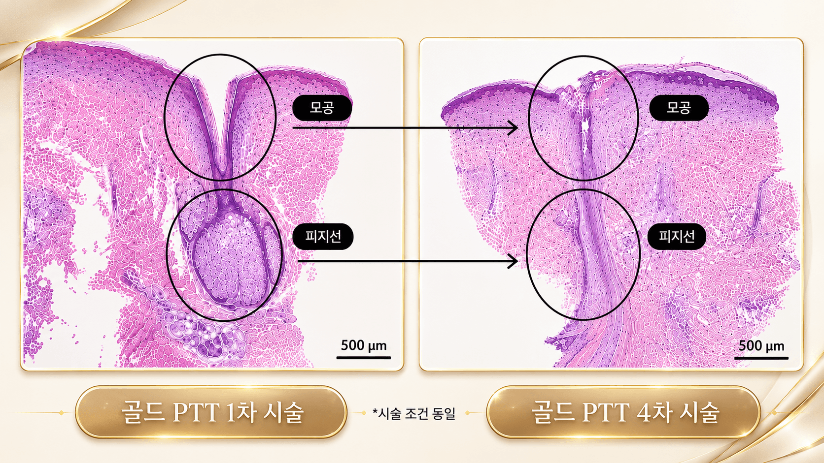 /images/07-skin-treatment/acne-goldptt-beforeafter.png 2Derma 골드 PTT 시술 전·후 — 골드 PTT 1차 시술 대비 4차 시술 모공·피지선 변화
