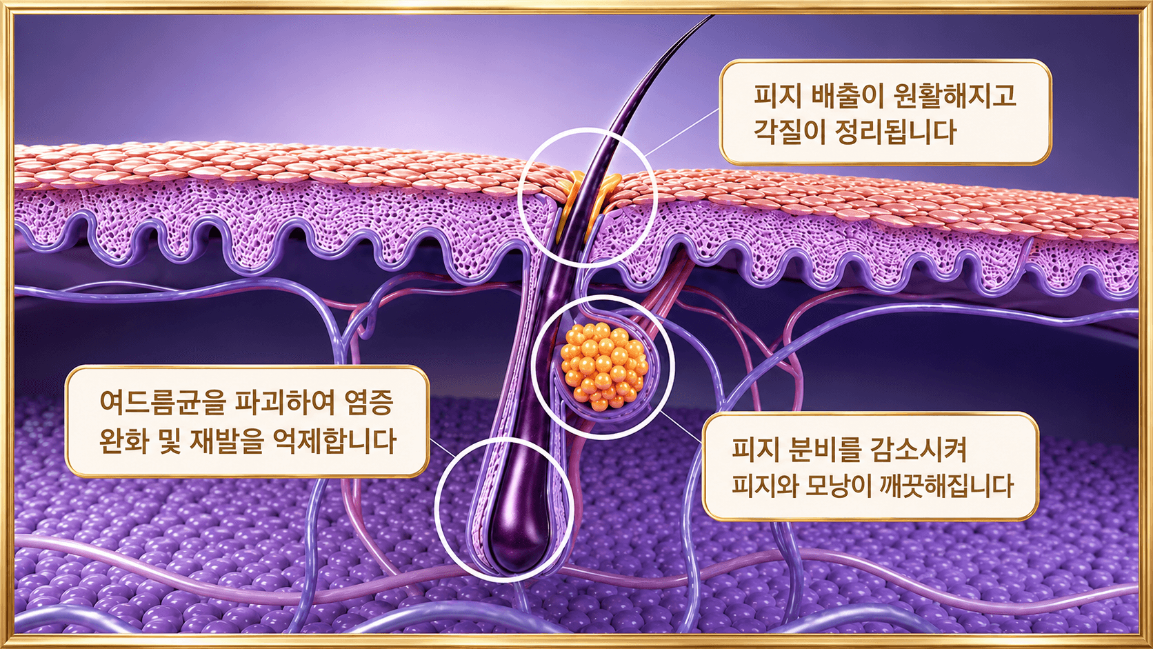 /images/07-skin-treatment/acne-goldptt-necessity.png 골드 PTT의 시술의 필요성 — 피지 배출·각질 정리, 여드름균 파괴, 피지 분비 감소