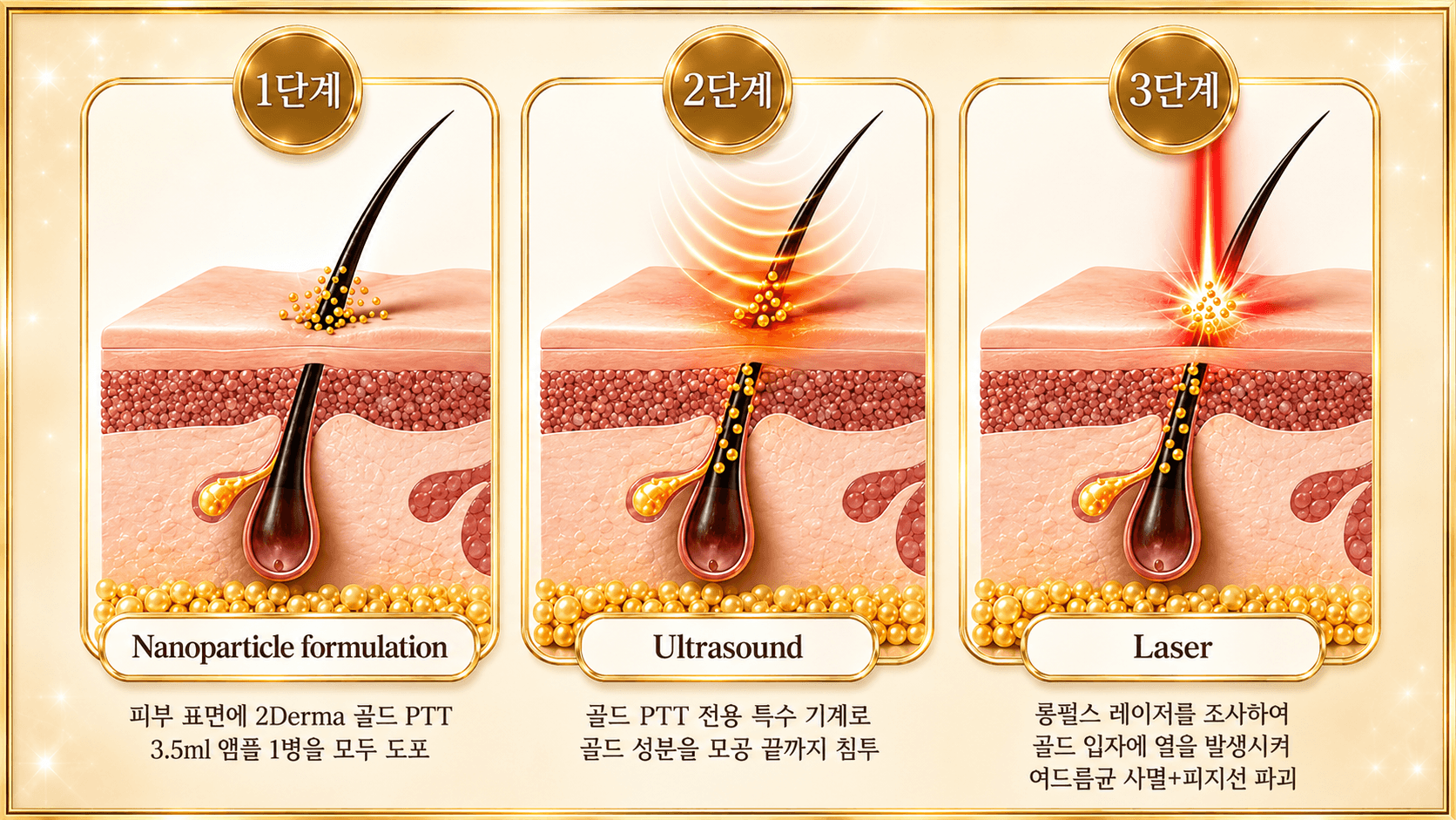 /images/07-skin-treatment/acne-goldptt-steps.png 골드 PTT 시술 순서 — 1단계 골드 PTT 도포 · 2단계 초음파 흡수 · 3단계 레이저 조사