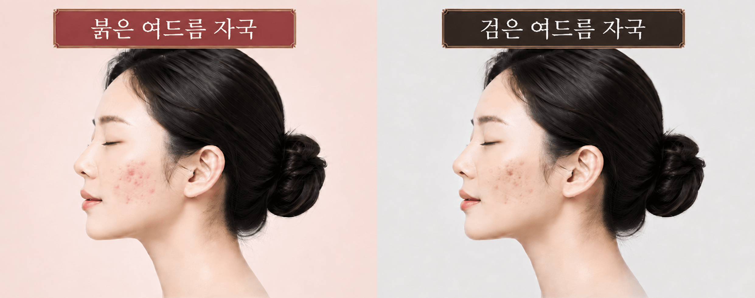 /images/07-skin-treatment/acne-marks.png 여드름 자국 — 붉은 여드름 자국 · 검은 여드름 자국