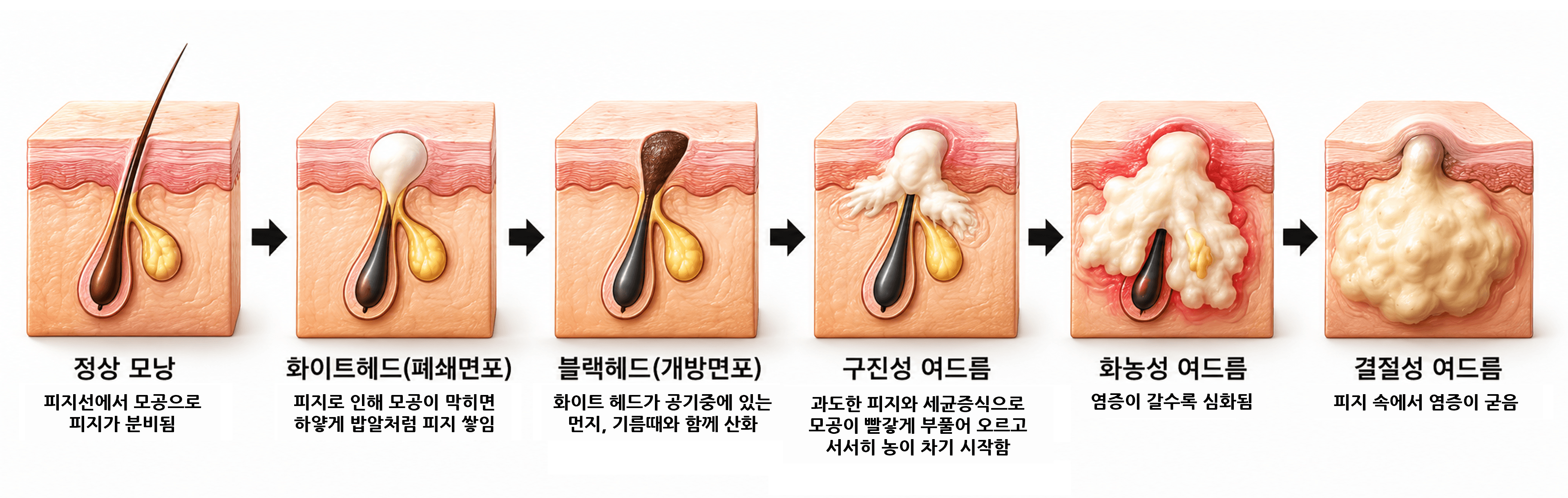 /images/07-skin-treatment/acne-process-diagram.png 여드름 발생 과정 — 정상 모낭 · 화이트헤드 · 블랙헤드 · 구진성 · 화농성 · 결절성 여드름