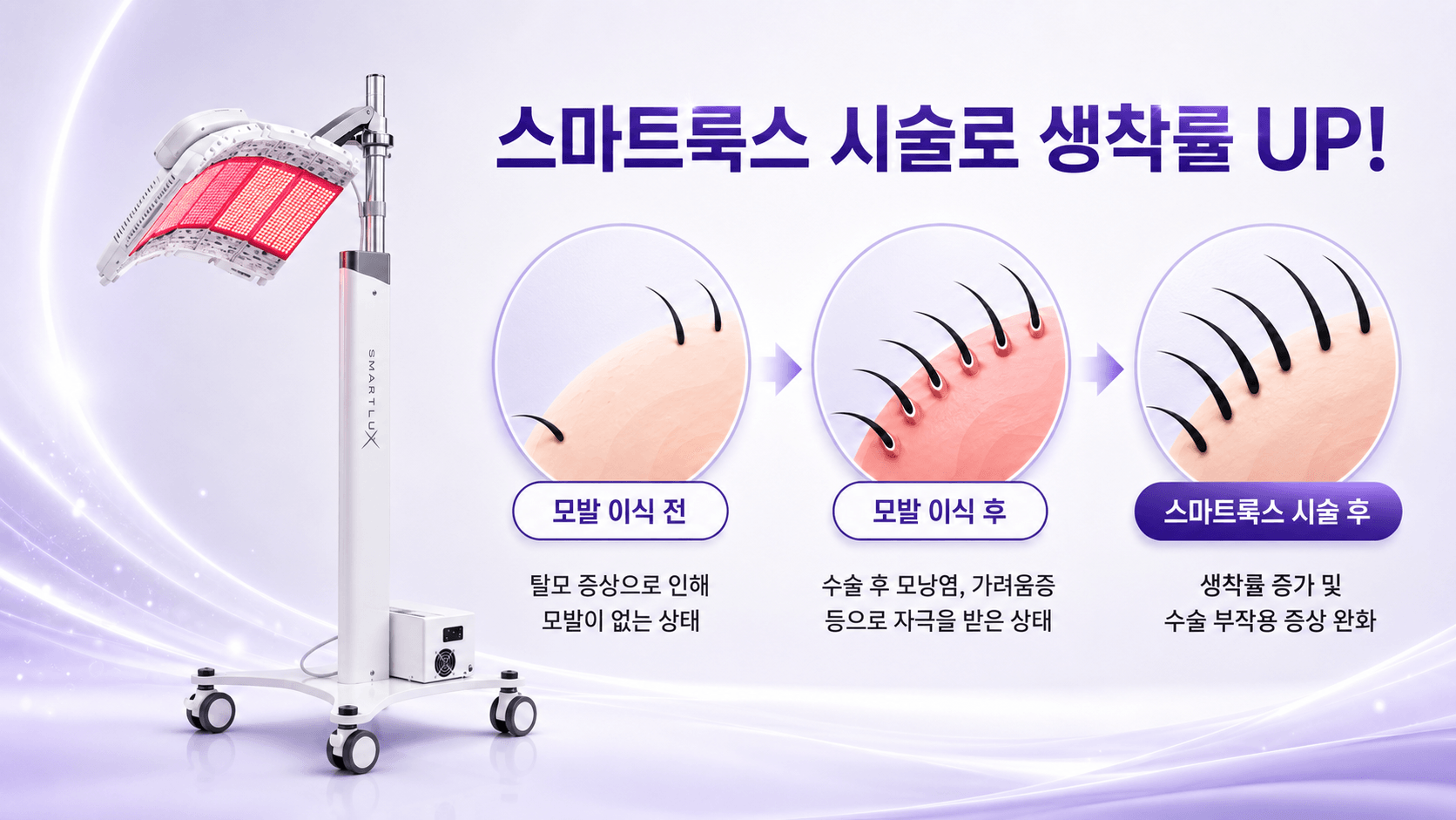 /images/07-skin-treatment/hairloss-smartlux-graft.png 스마트룩스 시술로 생착률 UP — 모발 이식 전 · 후 · 스마트룩스 시술 후