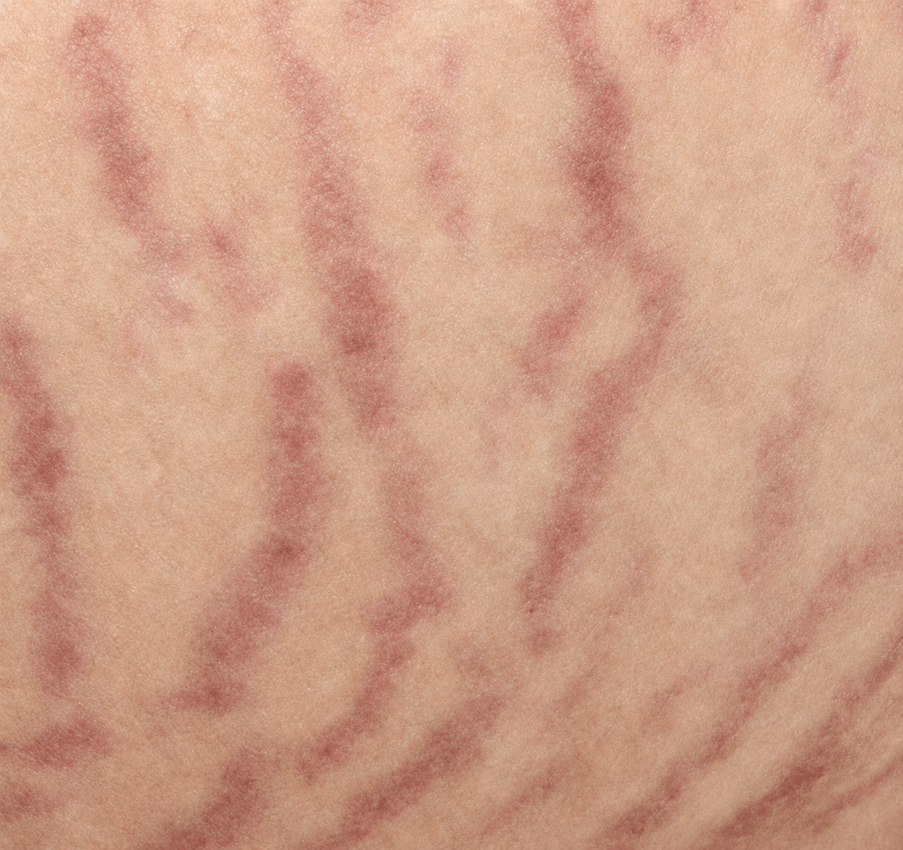 /images/07-skin-treatment/scar-stretch.png 튼살